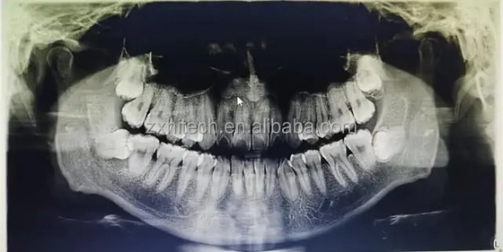 歯科CT 3D CBCT デジタルX線機器 中国